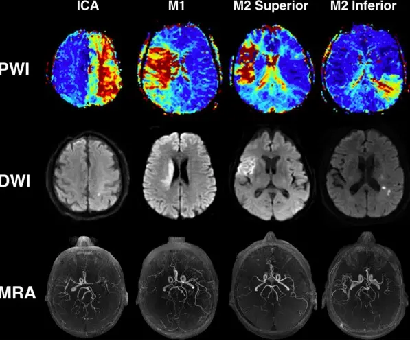 Функція МРТ Дифузійно-зважена магнітно-резонансна томографія МРТ DWI DW-MRI