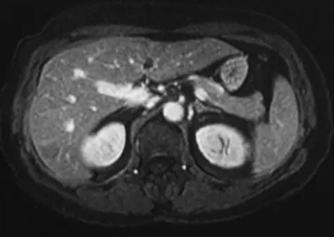 MRI scan with contrast in AversMED
